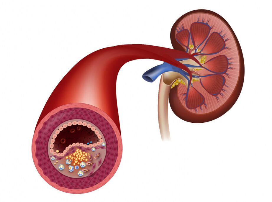 Reduce blood circulation due to atherosclerosis